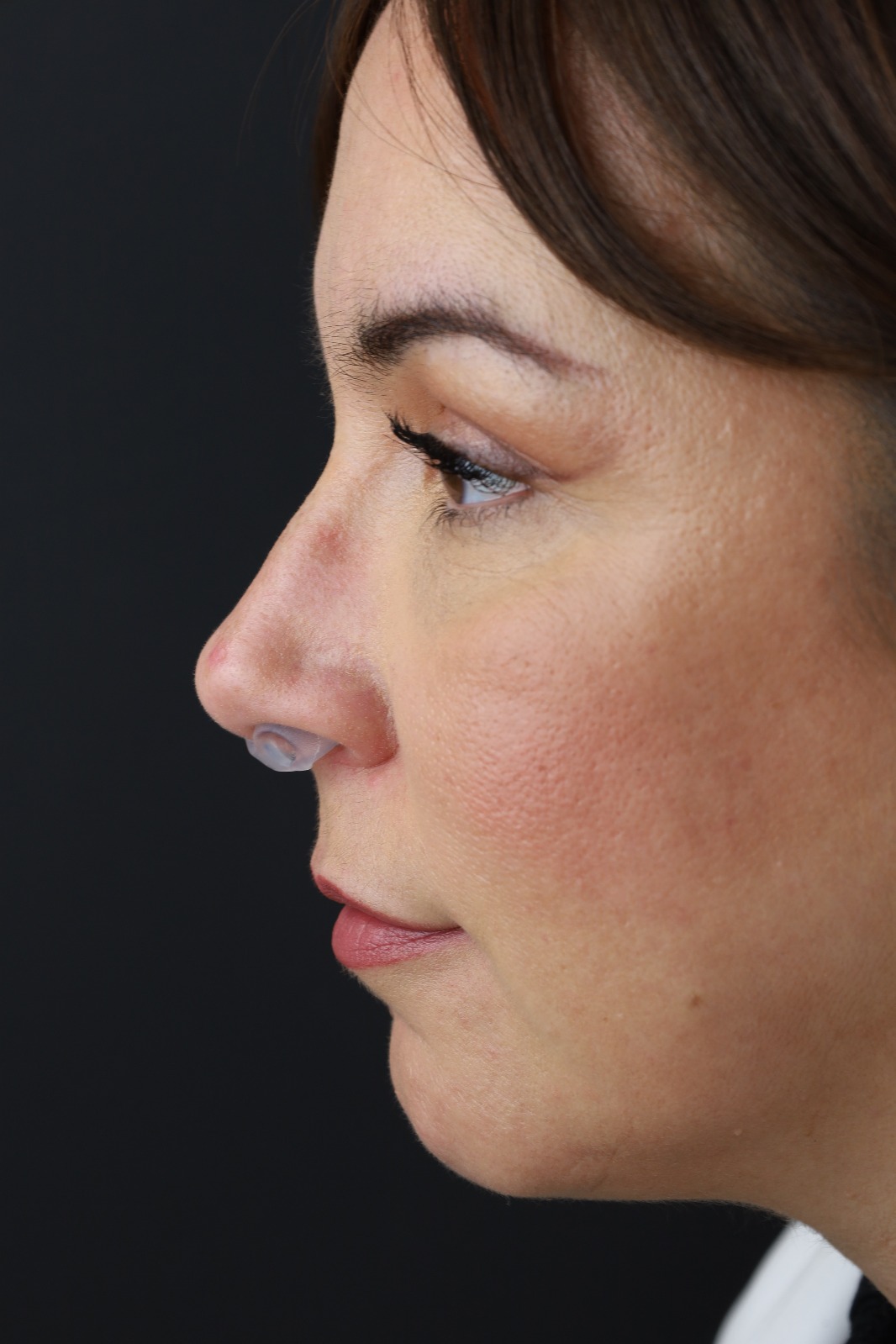 Postoperative Nasal Retainer – Pack of 10 - Image 6