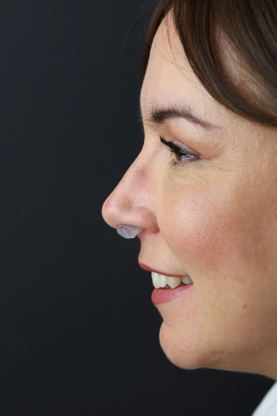 Postoperative Nasal Retainer – Pack of 10 - Image 8